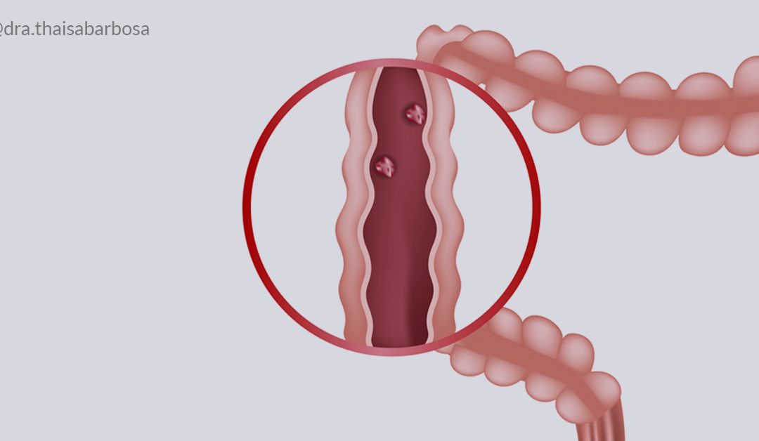 Pólipos intestinais: entenda porque é preciso identificar