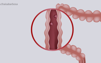 Pólipos intestinais: entenda porque é preciso identificar