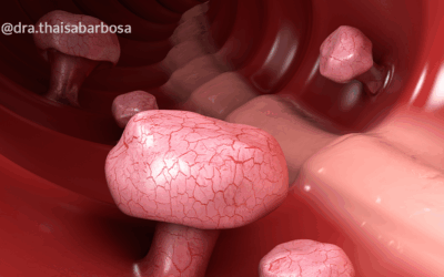 Remoção de pólipos intestinais: saiba quando ela é necessária