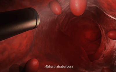 Pólipos intestinais: por que eles podem voltar a aparecer?