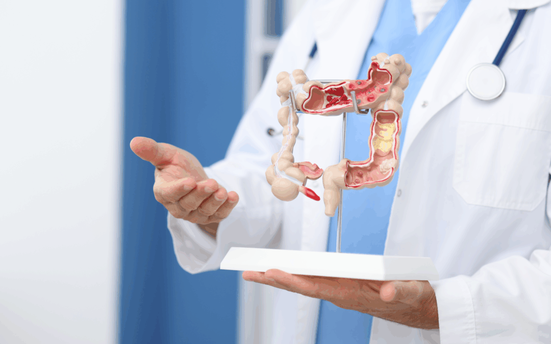 Quando a cirurgia robótica é indicada na endometriose intestinal?