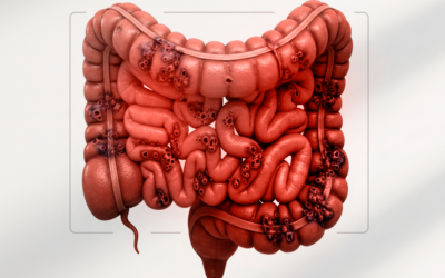 Quando a cirurgia passa a ser uma opção de tratamento para a endometriose intestinal?