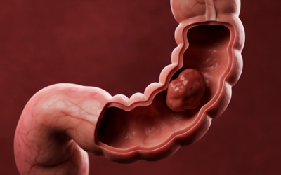 Tumor inicial x tumor avançado: como o tempo muda o plano de tratamento